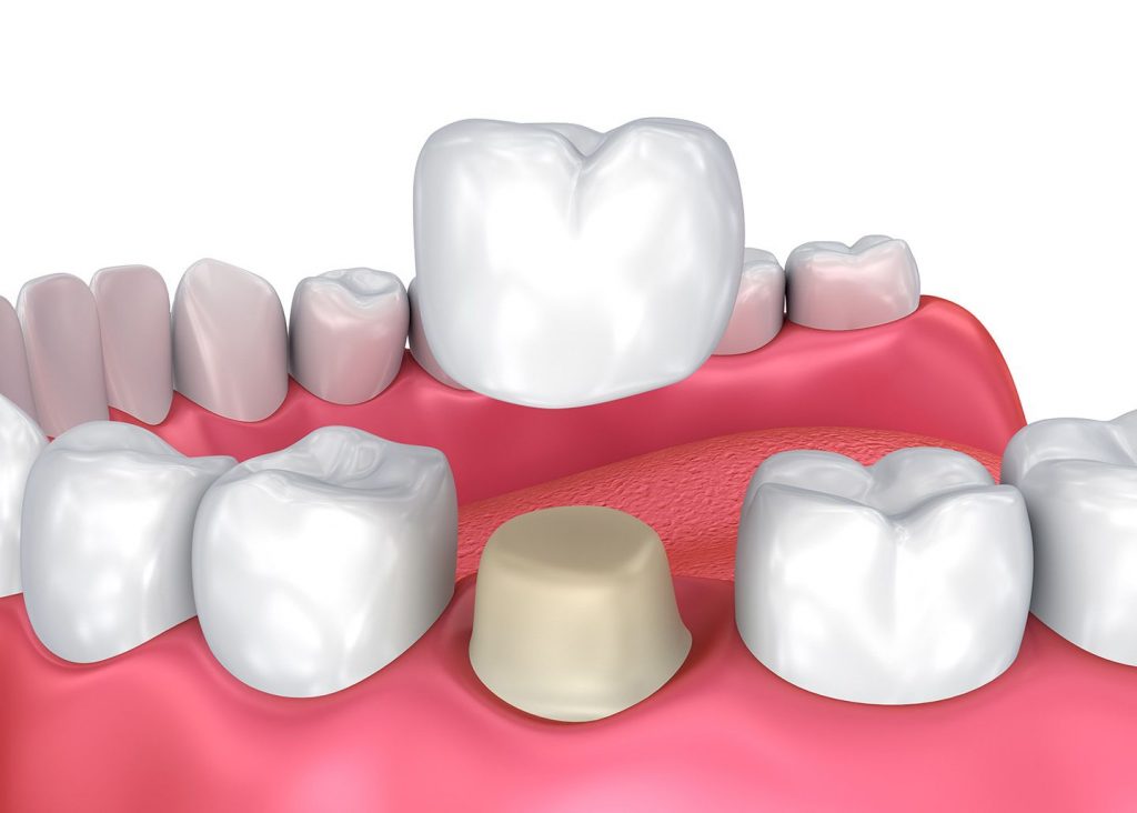 Dental Crown Protection for Weak Tooth