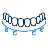 All Teeth On Four Dental Implants