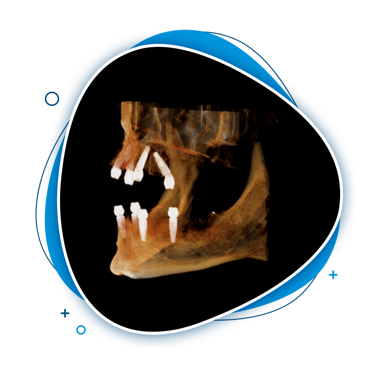 dental implants geelong