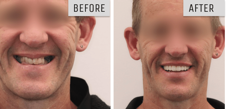 dental implant geelong