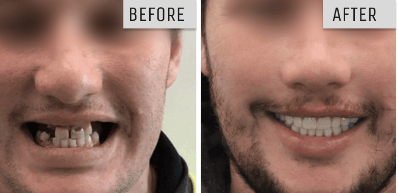 dental implants geelong