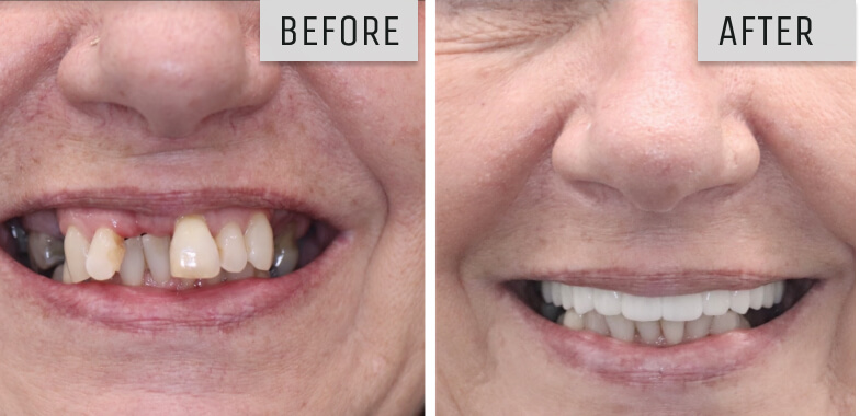 dental implant geelong