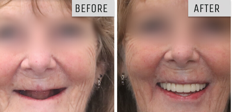 dental implants geelong