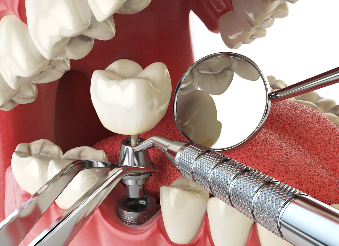 Dental Implants